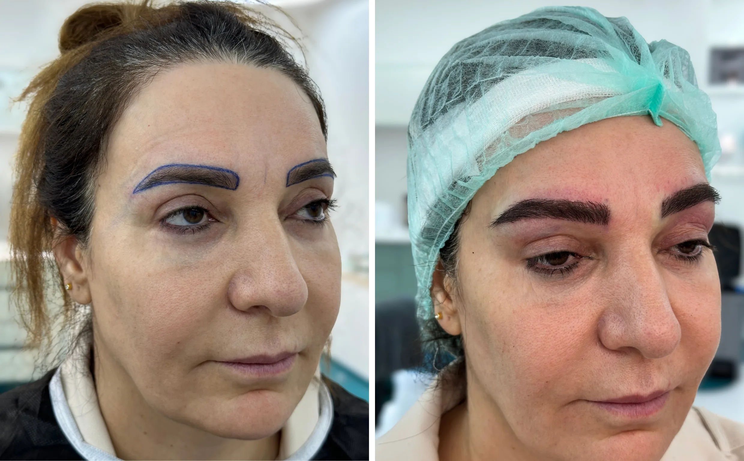 Solda işlem öncesi dörtte üç profilden portre, sağda yeşil boneyle aynı gün ekim sonrası kaşlar.