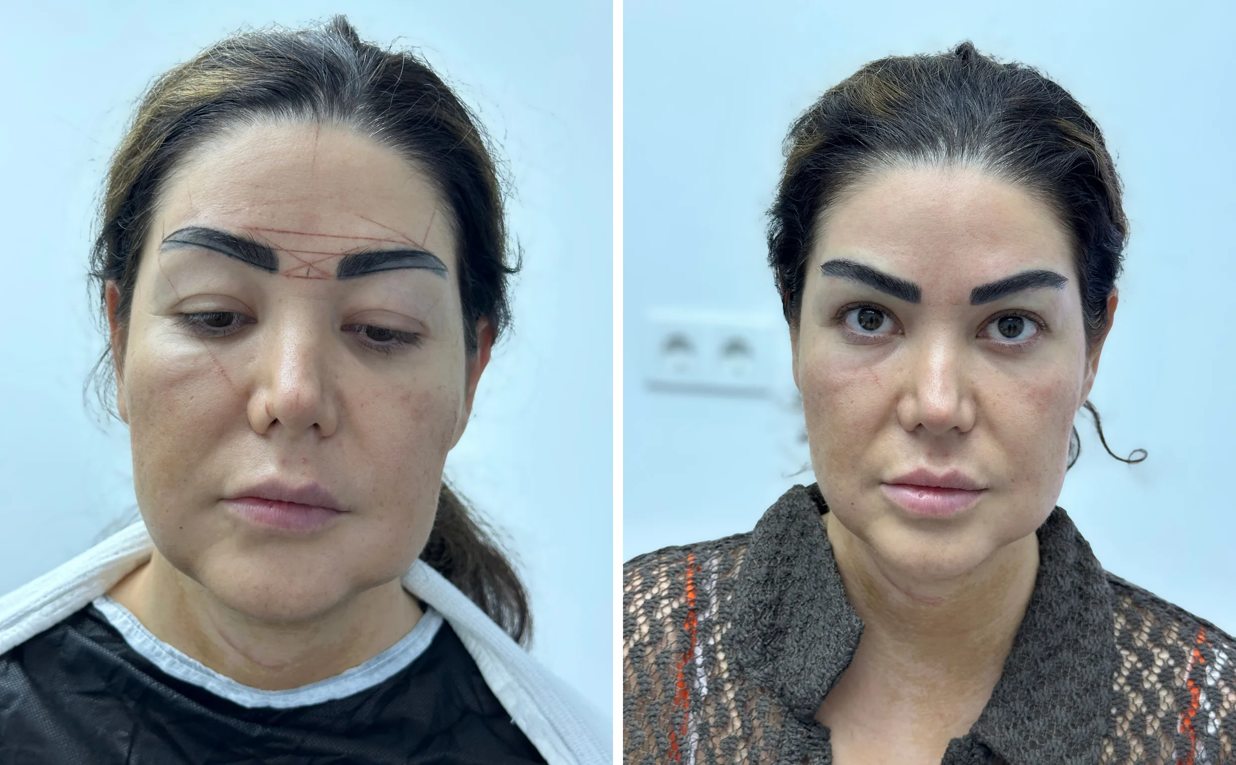 Solda işlem öncesi önden portre, sağda aynı gün ekim sonrası önden portre.