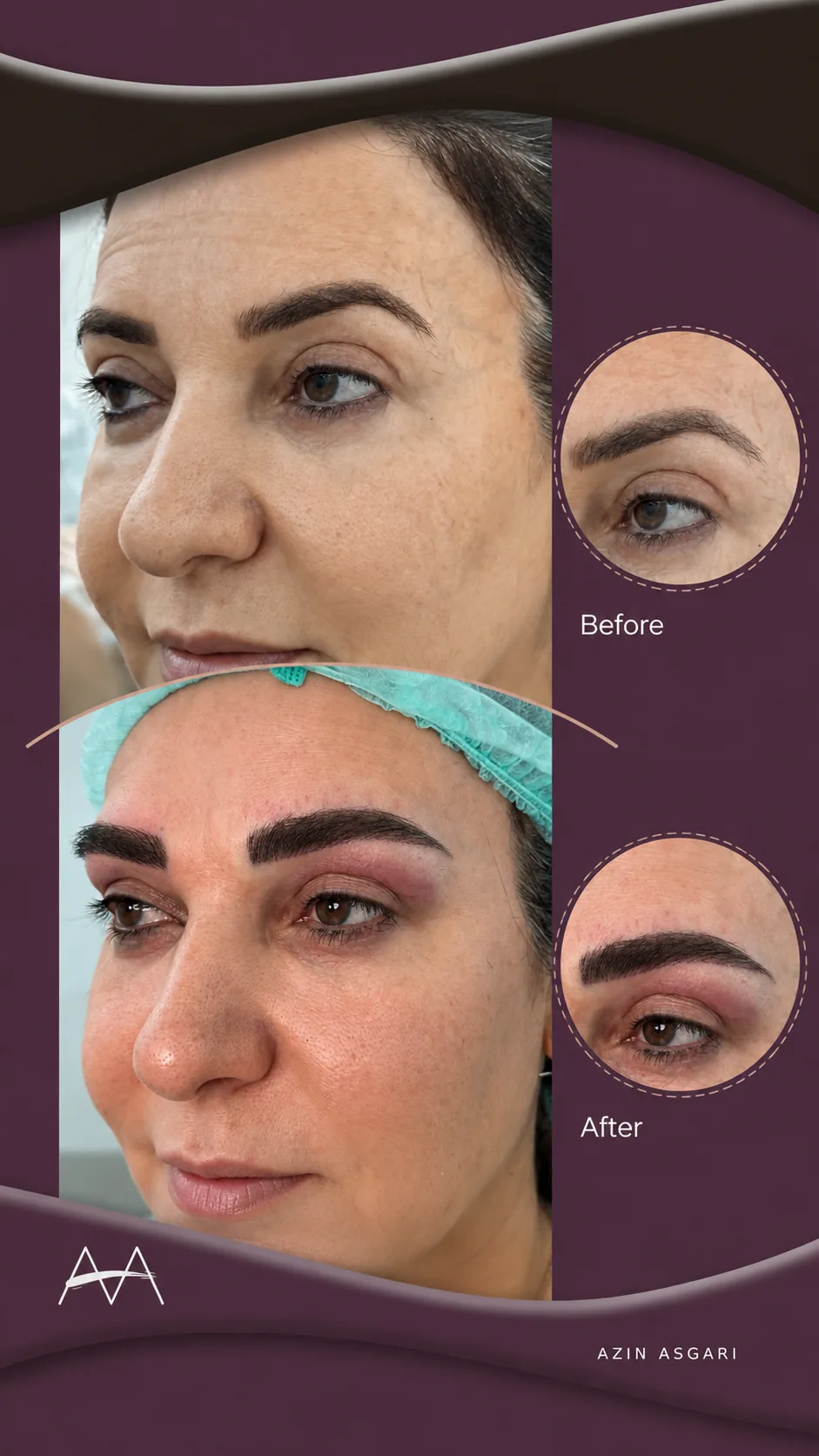 Üstte ekimden önceki kaşlar, altta ekimden sonraki hâli; yandaki dairelerde aynı kaşın yakın planı. Her iki kare de dörtte üç profilden çekilmiş.